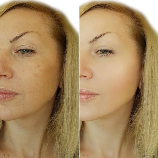 Blemish Balm Complex - Oil Soluble